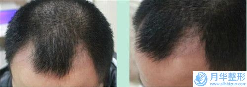 綏化打一針瘦臉針后可能出現(xiàn)哪些后遺癥