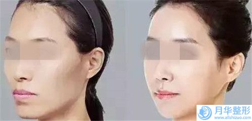 河池男人眉頭川字紋大概要花多少價(jià)格