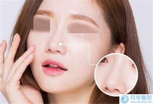 淮北鷹鉤鼻整型手術(shù)的副作用有什么呢