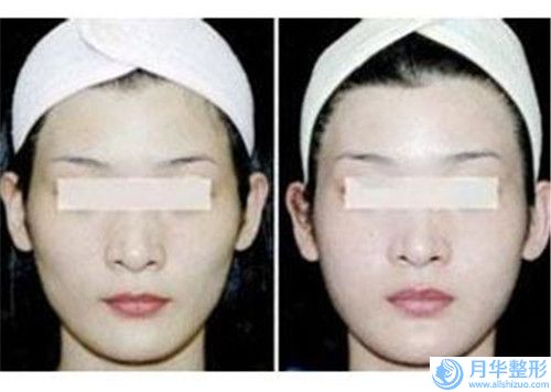 寧波美生源醫(yī)療美容醫(yī)院整形價目表2025在線參考-微創(chuàng)提眉案例