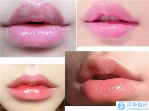 蚌埠假體隆下巴失敗修復(fù)整形手術(shù)主要針對的人群