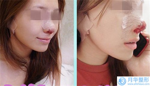 筋膜墊鼻尖容醫(yī)院推薦：筋膜墊鼻尖醫(yī)院前30均是實力派