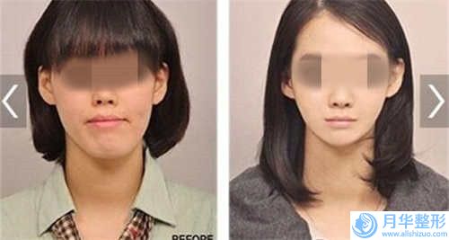 陜西省雙下巴抽脂手術(shù)醫(yī)生排名top10排行更新-雷馳醫(yī)生獨(dú)有技術(shù)_效果驚艷眾人