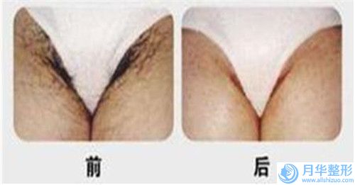 矯正后臉頰凹陷主要適應(yīng)那些人群