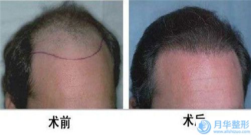 去除面部皺紋會影響正常生育嗎