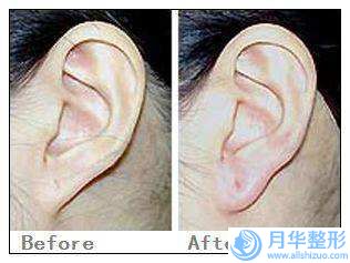 南平微創(chuàng)豐胸修復(fù)術(shù)費(fèi)用大致多少錢(qián)