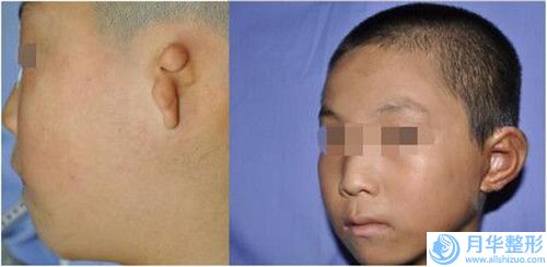 遼源自體脂肪豐胸二次填充整形手術(shù)費(fèi)用大致是多少