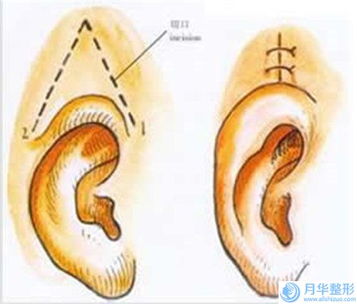 重慶第四人民醫(yī)院醫(yī)療美容整形科整形費(fèi)用表明細(xì)請(qǐng)看-男士胸部整形案例