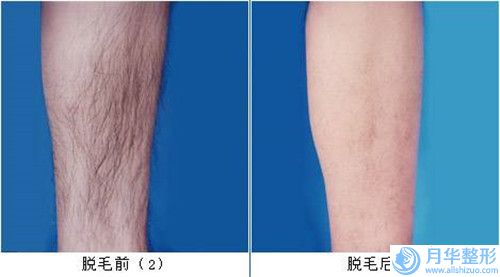 瓷貼面單顆會(huì)不會(huì)給身體帶來(lái)什么影響