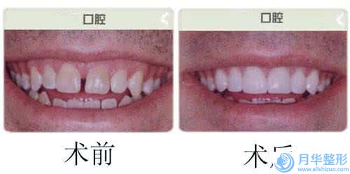 福州明宇匯美醫(yī)療美容超聲吸脂臀部減肥整形的費用貴不貴