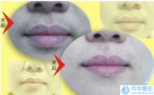 杭州維恩口腔門診部做面頰除皺術(shù)價格會受到哪些影響