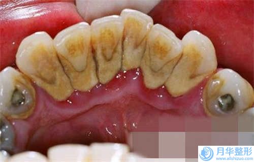 曾高大腿溶脂吸脂術能維持多久有哪些副作用