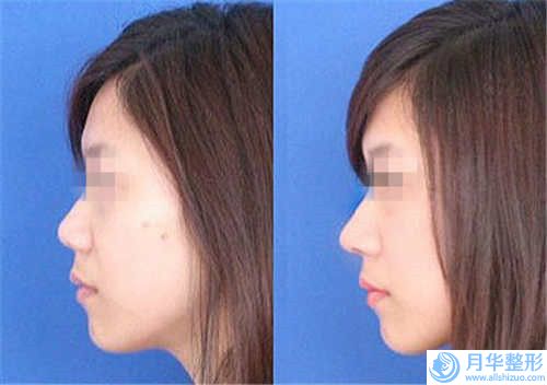 中山百佳婦產(chǎn)醫(yī)院脂肪豐下巴費(fèi)用及護(hù)理事項(xiàng)