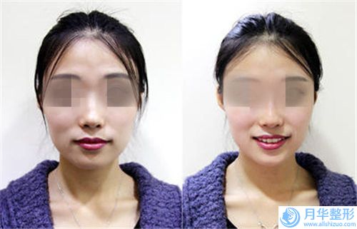 成都博愛醫(yī)院口腔科用耳軟骨墊鼻尖術(shù)大約要多少錢