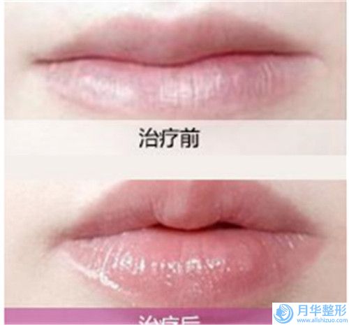 王和平自體脂肪顆粒注射下巴會帶來副作用嗎