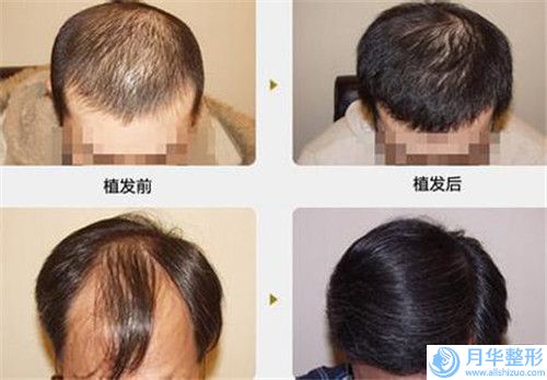 濰坊市醫(yī)院臉上疤痕去疤-益都中心醫(yī)院整形安全更有保障