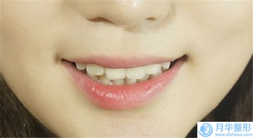 劉洋做大腿吸脂減肥后多久能看見理想的效果