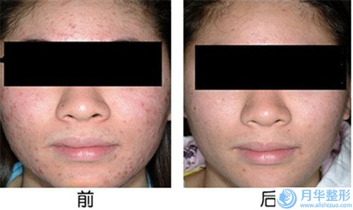 張婷自體脂肪填充蘋果肌術(shù)后會出現(xiàn)副作用嗎