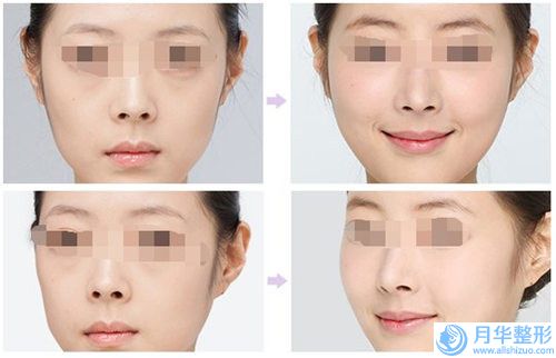 石首華美整形醫(yī)院鼻子毛孔粗大后怎么護理才能保證其效果