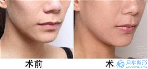 半紋眉手術(shù)的后遺癥及危害(半紋眉風(fēng)險性高嗎)