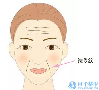 玻尿酸填充去法令紋是否有后遺癥呢