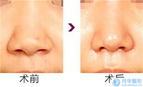 余成坤下巴矯正手術(shù)價格及術(shù)前準(zhǔn)備