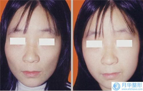 劉雁眉整形醫(yī)生-鄭州億鑫隆醫(yī)療美容診所劉雁眉醫(yī)生性價比，技術(shù)在線測評