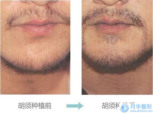赤峰學(xué)院附屬醫(yī)院整形外科面部抽脂打玻尿酸正規(guī)嗎手術(shù)案例-附整形價位表