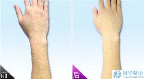 吉林大學(xué)第一醫(yī)院二部整形美容科臉痤瘡泛紅消除的醫(yī)生哪里做的好