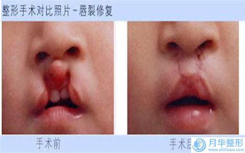 假體隆下巴手術(shù)術(shù)之后如何護(hù)理