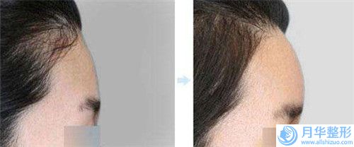 眼窩凹陷提眉失敗修復(fù)整形的適應(yīng)及禁忌人群有哪些