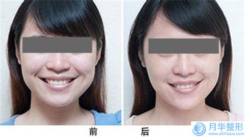攀枝花市二期唇裂修補(bǔ)醫(yī)生哪位技術(shù)牛-楊洪英整形醫(yī)生在榜三