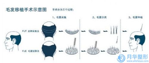 牙陶瓷貼面后應(yīng)該如何做好護(hù)理工作
