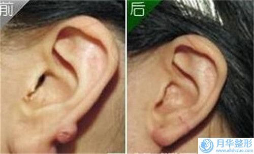 注射隆胸整形手術(shù)會(huì)有什么危險(xiǎn)
