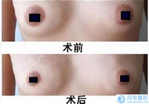 重慶美萊醫(yī)療整形美容醫(yī)院親測額頭長痘痘白色種去除案例細節(jié)
