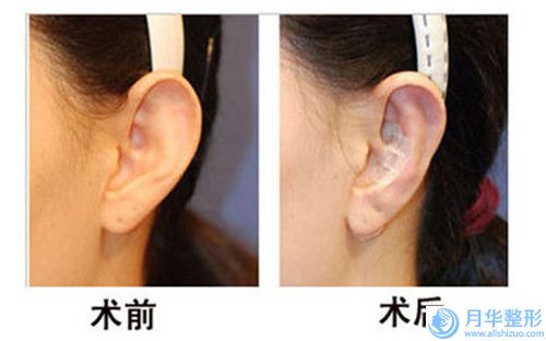 黃石市第二醫(yī)院皮膚美容科注射脂肪豐胸收費明細火熱發(fā)布-注射脂肪豐胸案例
