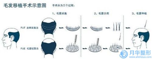 樸光哲自體脂肪自體脂肪豐臉什么價(jià)位
