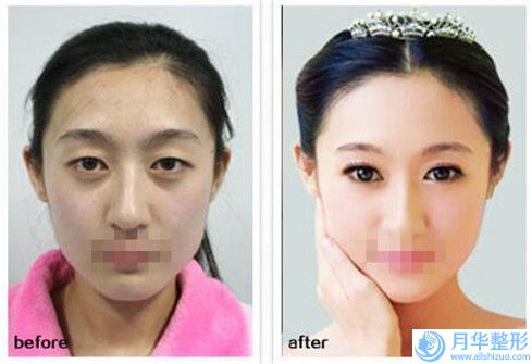 韓式雙眼皮形成術(shù)美容的安全性如何