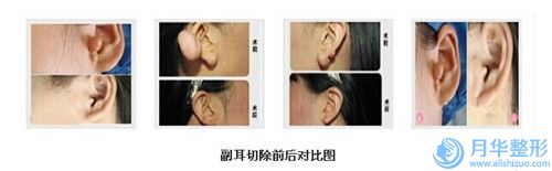 福州市韓式自體脂肪移植豐胸整形醫(yī)生哪個口碑好-虞守輝主任醫(yī)師醫(yī)生價格及案例口碑深解析