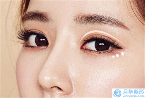 西寧美萊馨怡整形美容醫(yī)院咋地好不好｜王娜醫(yī)生歐式納米無(wú)痕雙眼皮如何