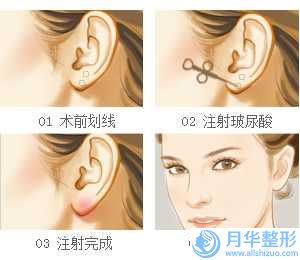 上海第七人民醫(yī)院燒傷整形科韓式隆胸整容價(jià)格收費(fèi)表2025年出爐-韓式隆胸整容案例