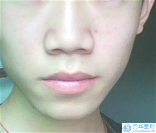 呂寧鼻骨矯正術(shù)術(shù)可以保持多久的時間