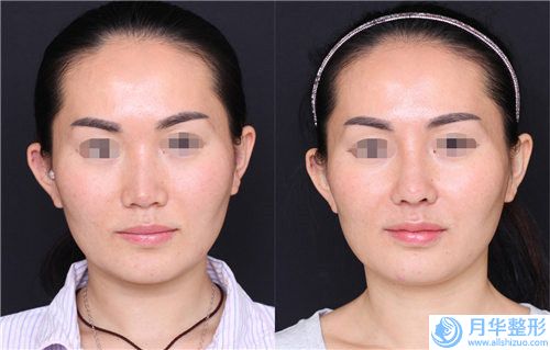 國內(nèi)硅膠假體隆鼻失敗修復術(shù)醫(yī)院推薦：硅膠假體隆鼻失敗修復術(shù)醫(yī)院50強排名分享