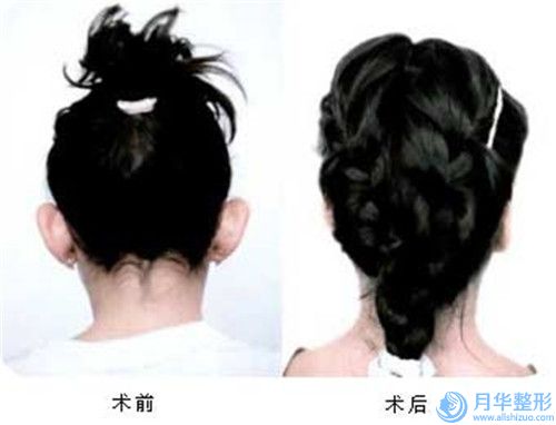 威海市自體脂肪假體豐胸美容醫(yī)院哪家實力棒-自體脂肪假體豐胸整形價格貴嗎