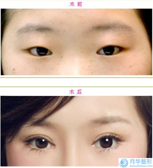 湖州市fotona眼袋價(jià)位表2025名氣專家拔草-近8個(gè)月均價(jià)為5062元