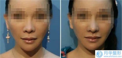 宜昌市李長青整形醫(yī)生手術(shù)隆下巴費用及適合人群