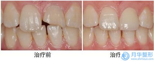 張選奮醫(yī)生自身脂肪填充耳垂案例-價(jià)格收費(fèi)表爆出