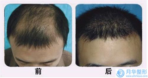 常州市活細(xì)胞全臉填充收費(fèi)標(biāo)準(zhǔn)詳細(xì)爆出(活細(xì)胞全臉填充均價(jià)為：9938元)