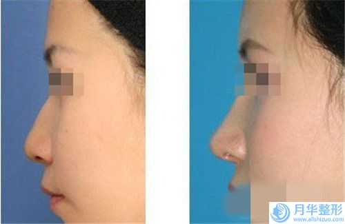 河北省的隆鼻耳軟骨醫(yī)院推薦：隆鼻耳軟骨醫(yī)院前30佳口碑一一揭曉