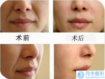 中山市激光點(diǎn)痣在做費(fèi)用貴嗎-價(jià)格在698元起